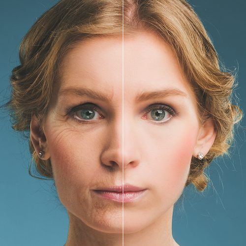 Portrait,Of,A,Woman,Before,And,After,Botox.,Young,And