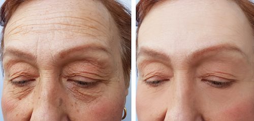 Face,Of,An,Elderly,Woman,Wrinkles,Face,Before,And,After